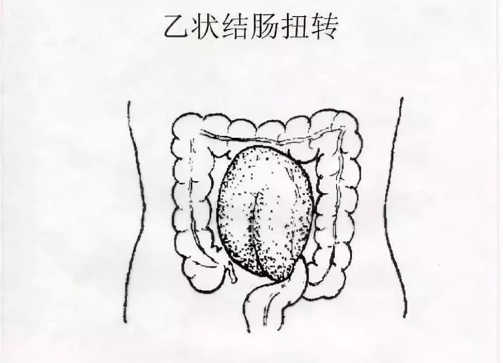 原本只想好好跳个舞,没想到把肠子给"扭"了!