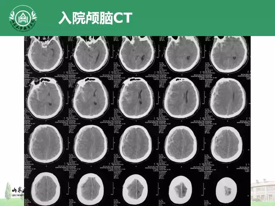 精彩点评成功的合并致命并发症的重型颅脑损伤救治病例,并发症发现