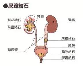 结石可见于肾,膀胱,输尿管和尿道的任何部位.