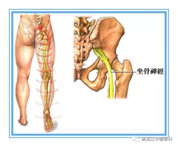 到底是哪些因素导致的坐骨神经痛?您都知道吗?