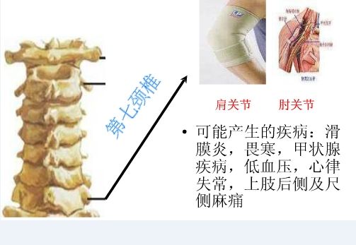 颈椎错位怎么办