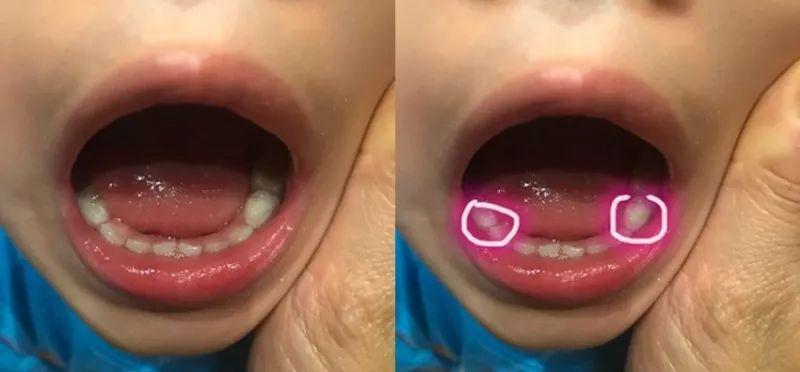 抗龋一年，三岁小孩终于补牙成功！