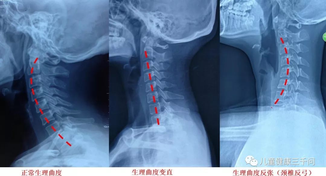 不可忽视的颈椎病,颈椎不舒服的点进来