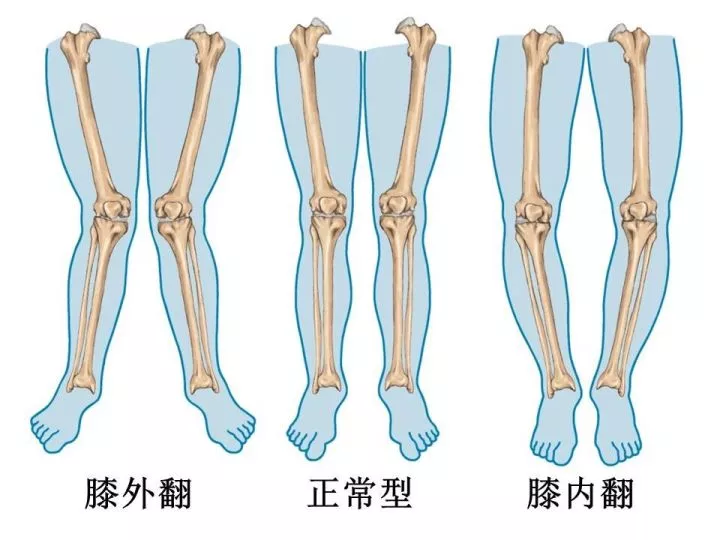 孩子x,o型腿,走路八字怎么破?教你8招,在家治好!