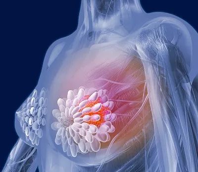 乳腺增生性乳房疼痛:乳腺增生性疼痛可向腋下,肩背部放射,手触乳房可