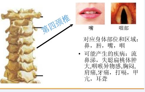 颈椎错位怎么办