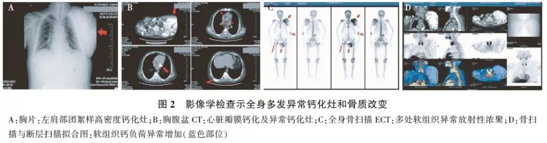 1)全身骨质表现,结合临床考虑为代谢性骨病改变(全身骨扫描ect(甲状