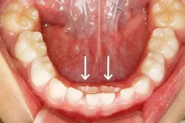 牙没掉就长新牙怎么办