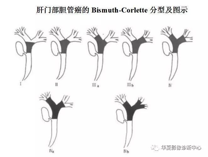 【影像进阶】肝门胆管癌的诊断和分型