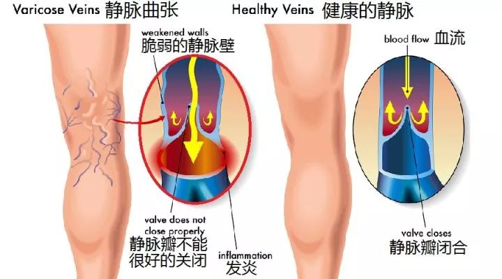 左小腿静脉曲张怎么办