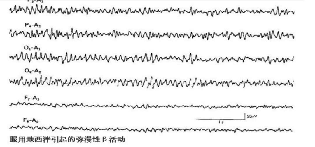 脑电图入门攻略