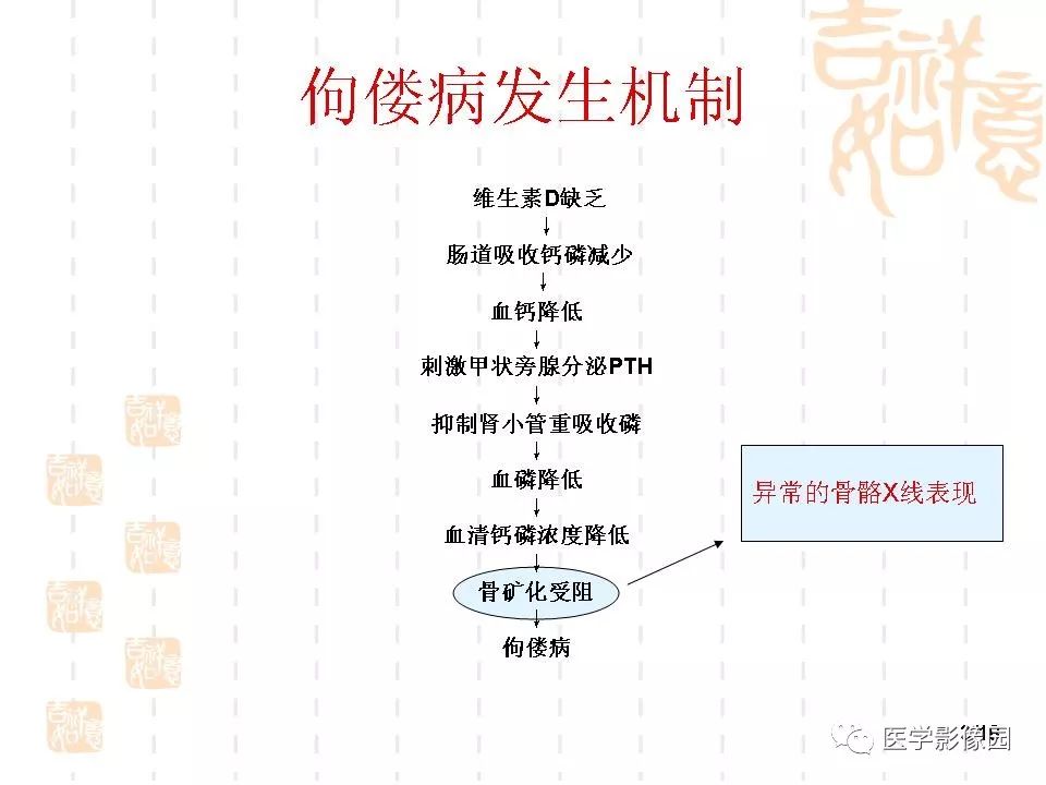 佝偻病的影像学特点 | 影像天地