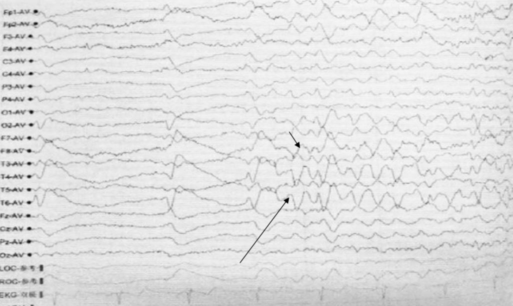 始就诊于当地县人民医院,头颅mri示腔隙性脑梗死,脑电图未见异常,经