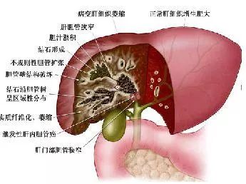 胆囊有息肉,切还是不切?