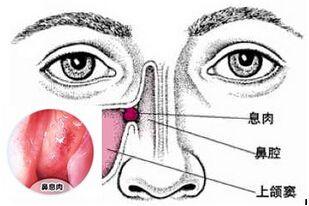 首大刘玉梅:鼻窦炎如此"青睐"年轻人,是何原因