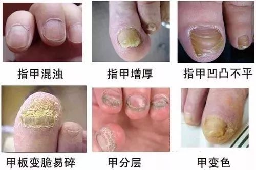 灰指甲是甲癣的俗称,指的是甲板或甲下组织感染了真菌,指甲就变得灰