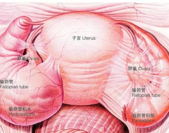 或因粘连闭锁,粘膜细胞的分泌液积存于管腔内,或因输卵管炎症发生峡部