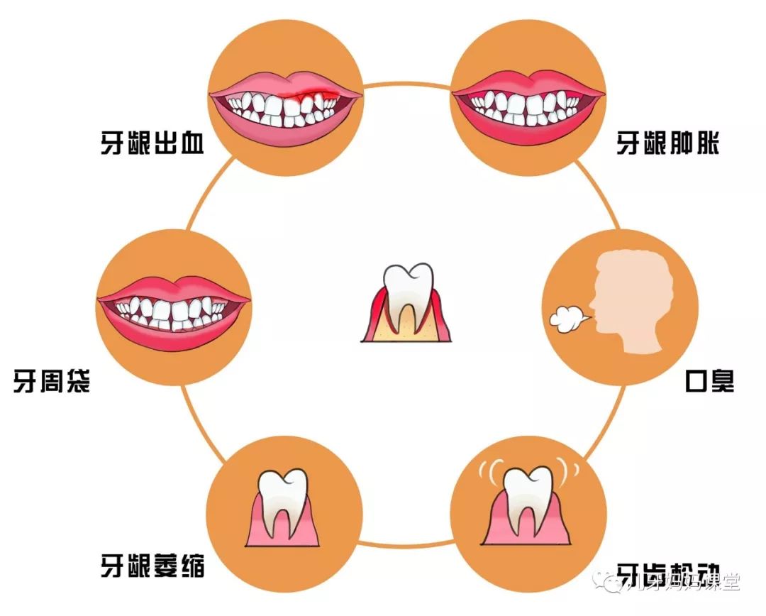 牙周炎的症状