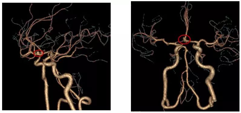 为求进一步治疗前来惠州三院,头颅cta检查提示:前交通动脉瘤