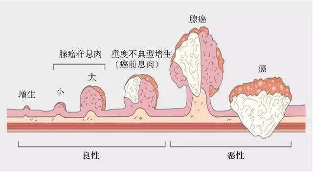 肠息肉若发展成炎性息肉,腺瘤 ,增生性息肉,乳头状腺瘤,儿童性息肉等