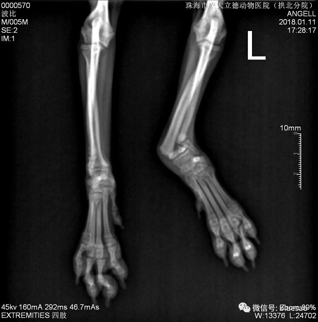 儿童Salter-Harris 2型桡骨远端骨骺损伤治疗分享 - 病例中心(诊疗助手) - 爱爱医医学网
