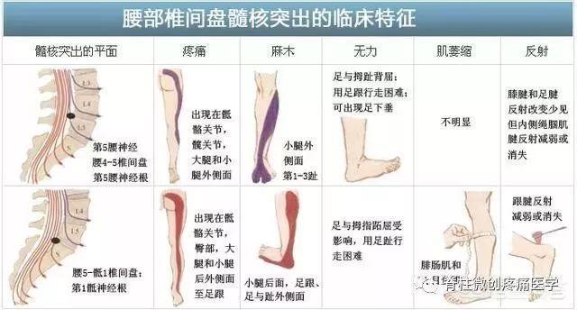 腰间盘突出压迫神经应该注意这些