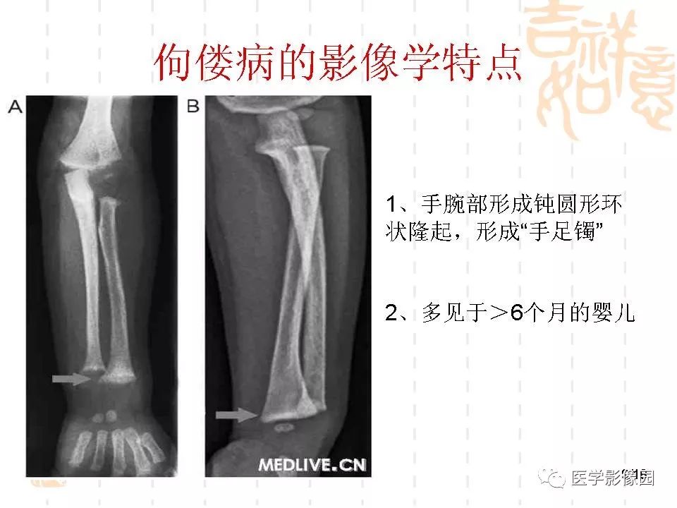 佝偻病的影像学特点