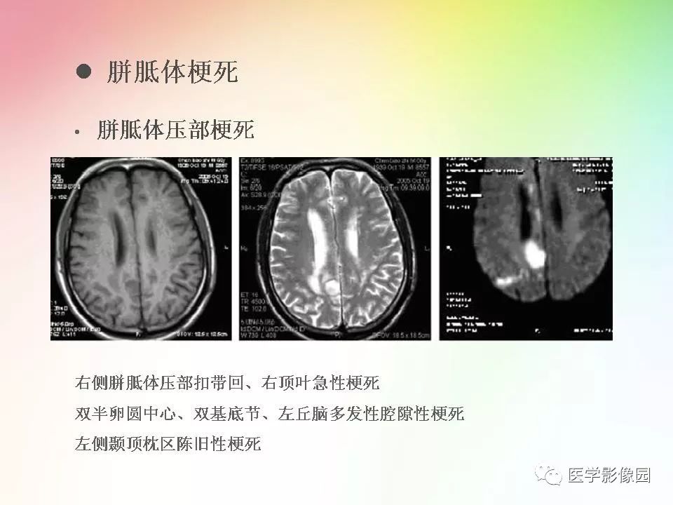 胼胝体病变影像学表现 | 影像天地