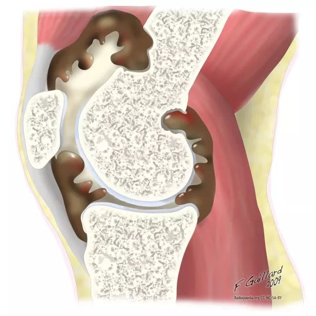 弥漫型:弥漫性滑膜增生,膝关节周围髌下脂肪垫区,髌上囊,腘窝内可见