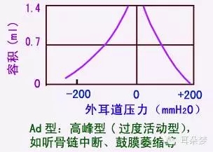 c型:鼓室负压型,图表现为峰压点