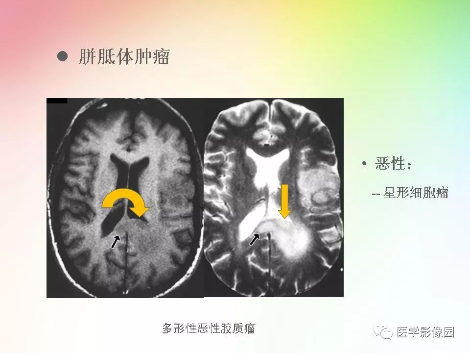 胼胝体病变影像学表现 | 影像天地