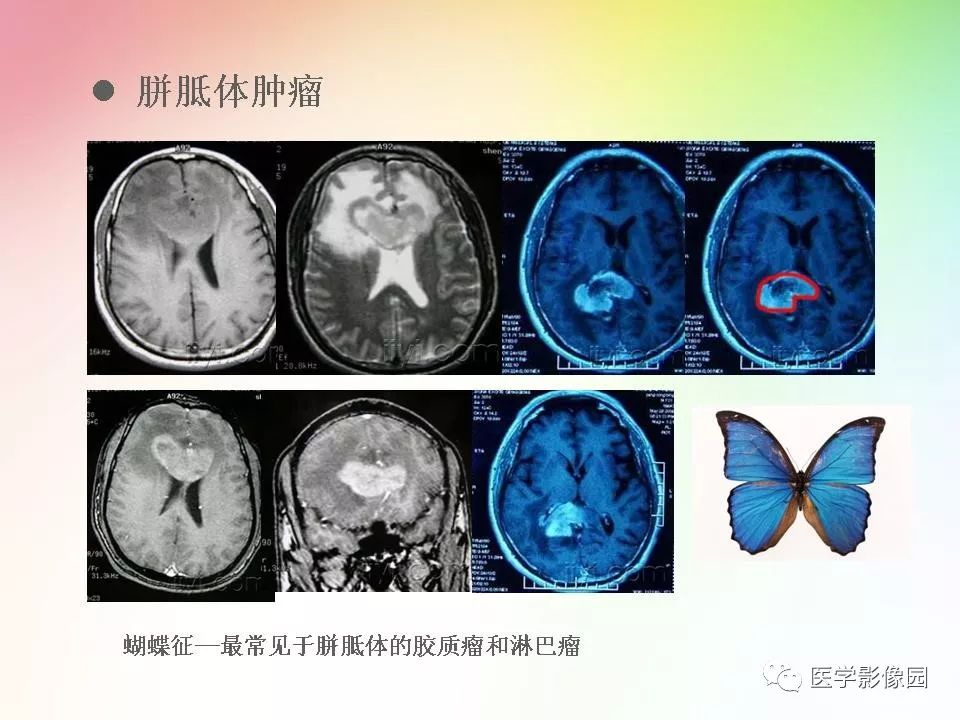 胼胝体病变影像学表现影像天地