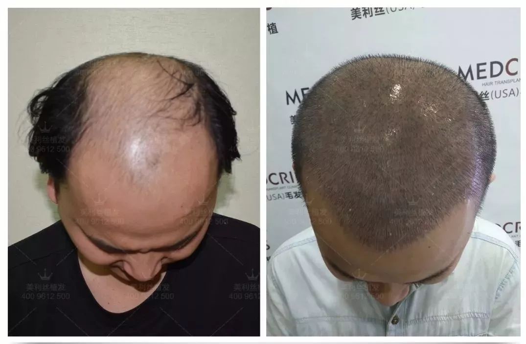 许欣植发前与植发后10天效果对比