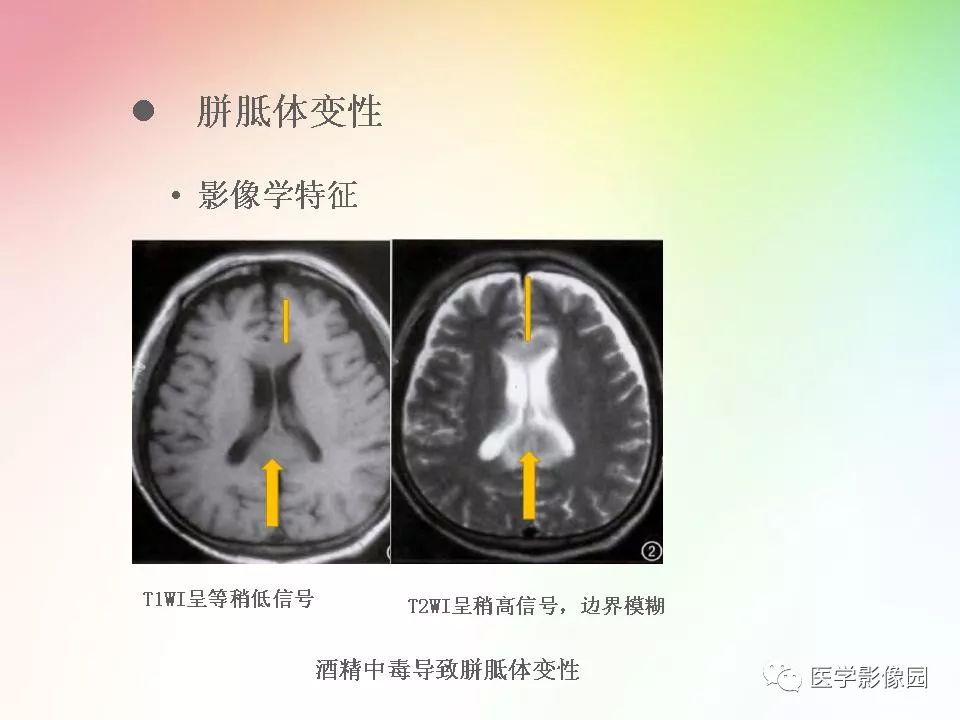 胼胝体病变影像学表现 | 影像天地