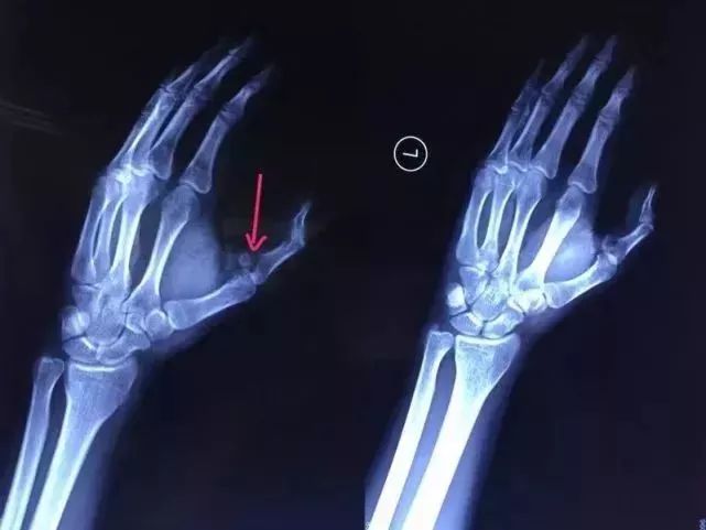 (x光检查发现,左手拇指骨折)