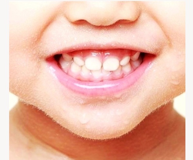 孩子换牙后牙齿畸形该怎么办?