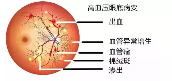 高血压是如何隐形"杀人"的?高血压朋友不要错过