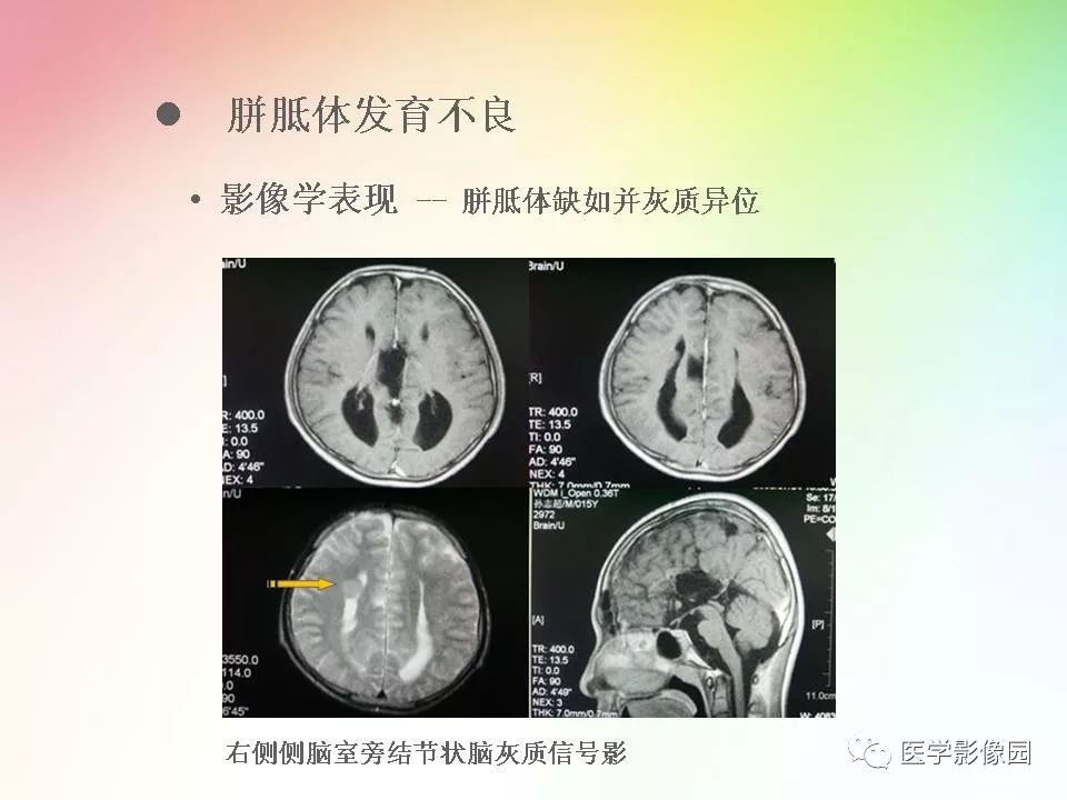 胼胝体病变影像学表现 | 影像天地