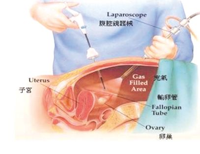 妇科腹腔镜术后护理_手机搜狐网