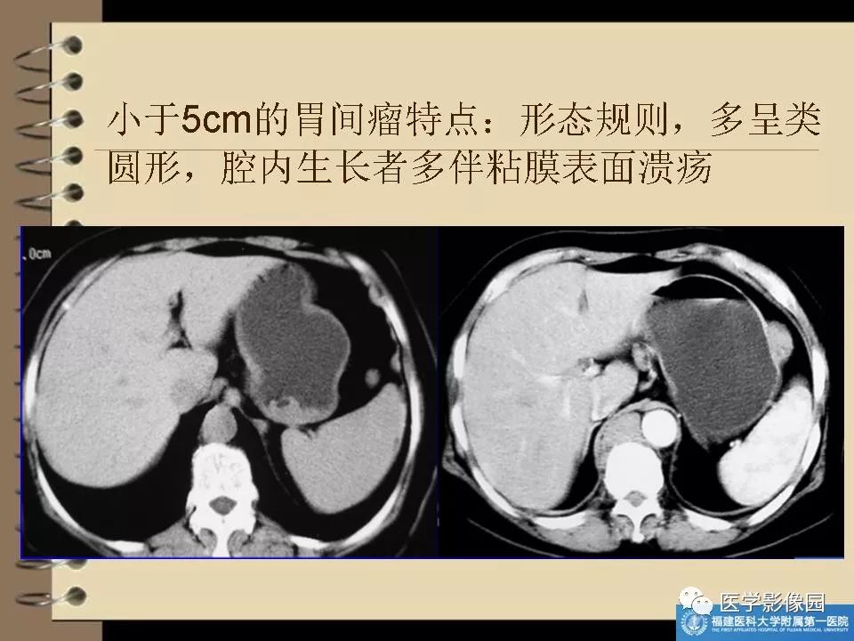 胃间质瘤的ct诊断与鉴别诊断 | 影像天地