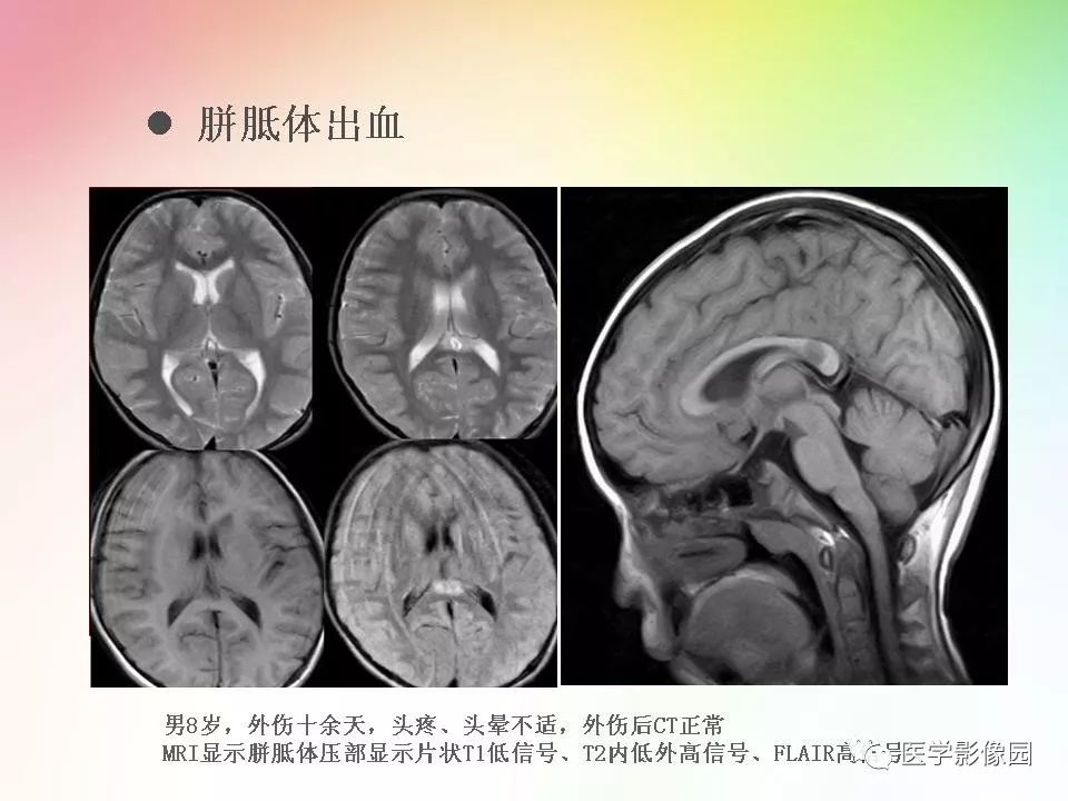 胼胝体病变影像学表现 | 影像天地