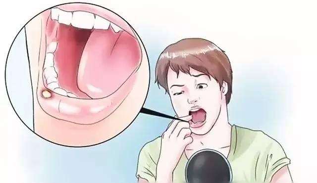 小儿口腔溃疡怎么办?该如何缓解小儿口腔溃疡?
