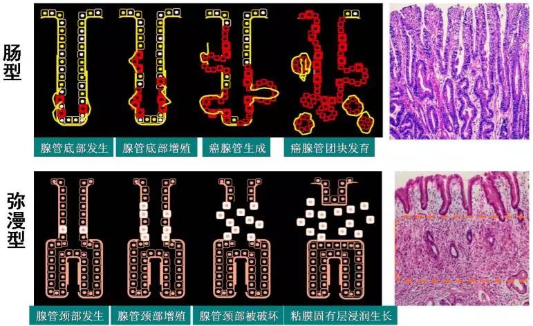 根据lauren胃癌病理分型,胃癌分为肠型和弥漫型,其中以肠型多见,为