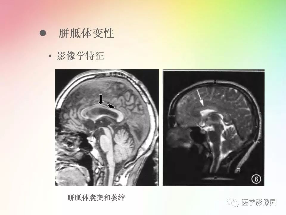 胼胝体病变影像学表现影像天地