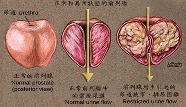 慢性前列腺炎请问怎么治疗才能根治