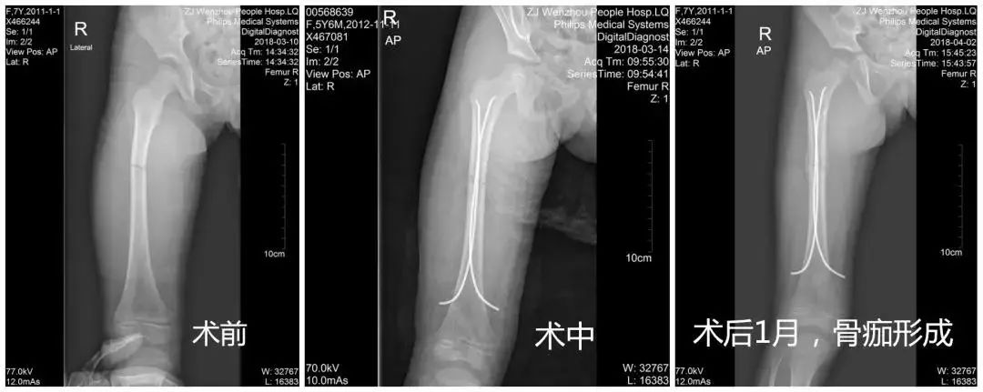 复查片子显示,骨折端骨痂形成良好,骨折线已模糊,股骨无畸形生长.