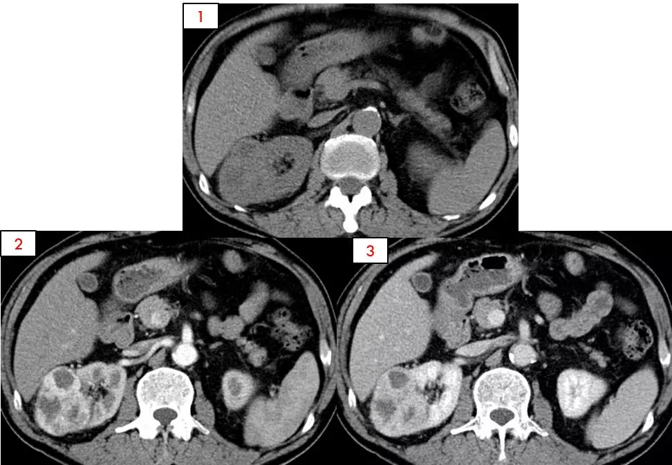肾癌进展—肾细胞癌的ct和mri诊断及鉴别诊断要点