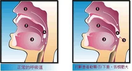 打鼾固然很可怕,但是除了治疗,我们还可以做这4件事,赶走呼噜声.