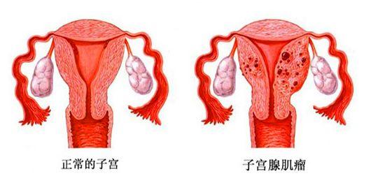 子宫内膜跑到子宫肌层就可能形成腺肌症