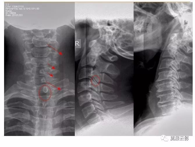 滑脱在颈椎多发生在c3,4,在一般情况下,颈椎的滑脱多发生在椎间隙变窄